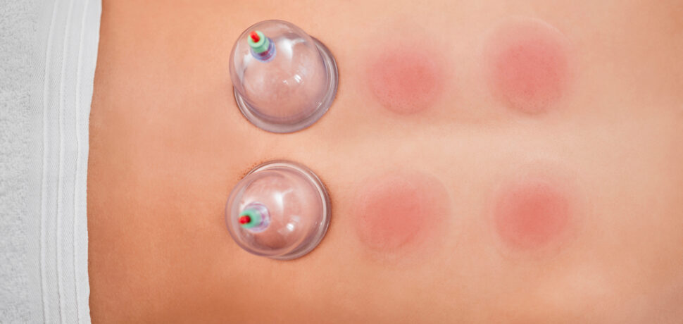 Cupping, therapy and spa with a woman customer lying on a massage table in a beauty center from abo.