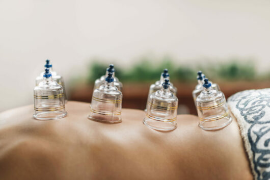 Hijama cupping treatment on women's back